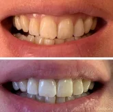 Студия косметического отбеливания зубов Lucky Smile фото 7